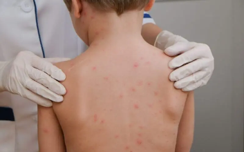 Meningite preocupa na PB: Estado confirma 38 casos e registra 11 mortes em 2026