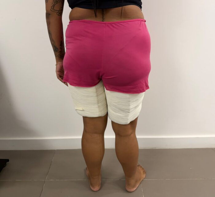 Polícia Federal prende passageira com drogas presas nas coxas no Aeroporto da Grande João Pessoa Polícia Federal prende passageira com drogas presas nas coxas no Aeroporto da Grande João Pessoa